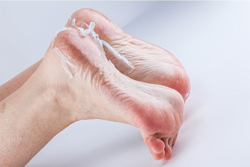 Five Foot Problems That Often Come With Age