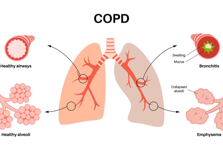 Chronic obstructive pulmonary disease Chronic obstructive pulmonary disease