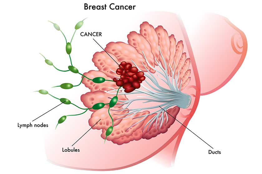 breast cancer breast cancer