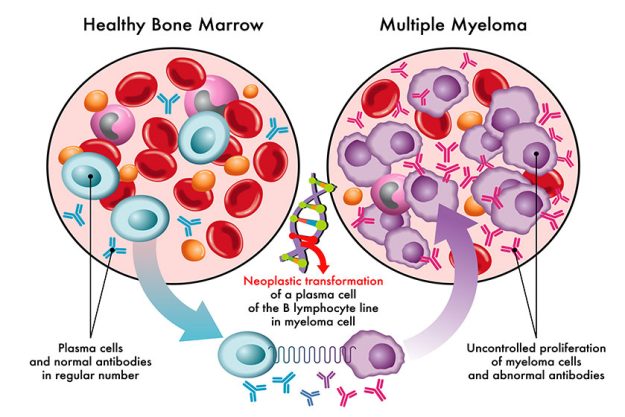 Medical illustration showing transformation plasma cells healthy bone marrow myeloma