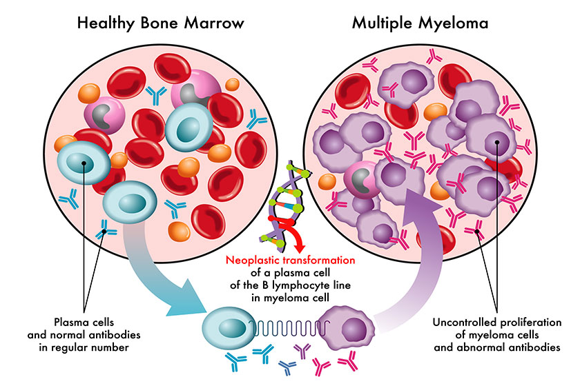 Medical illustration showing transformation plasma cells healthy bone marrow myeloma Medical illustration showing transformation plasma cells healthy bone marrow myeloma