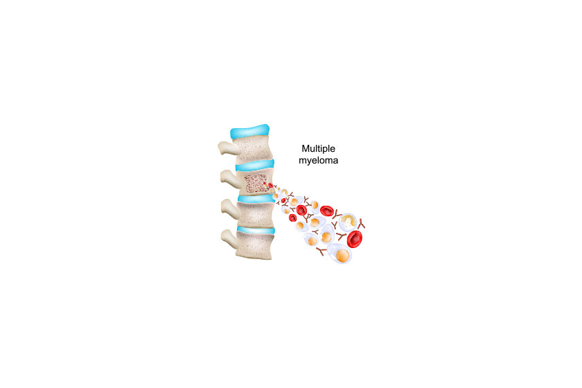Multiple myeloma part vertebral column cross section vertebra bone structure Multiple myeloma part vertebral column cross section vertebra bone structure