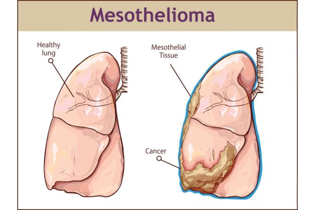Vector illustration of a Pleural mesothelioma.