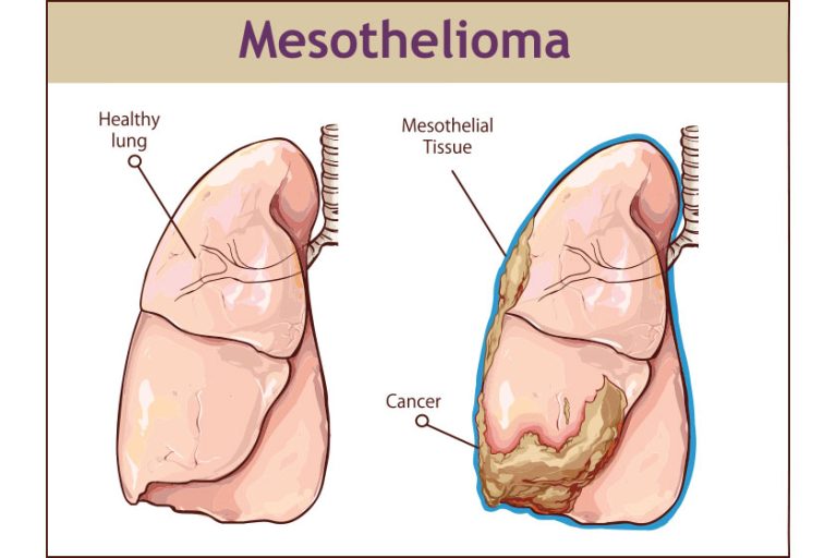Vector illustration of a Pleural mesothelioma. Vector illustration of a Pleural mesothelioma.