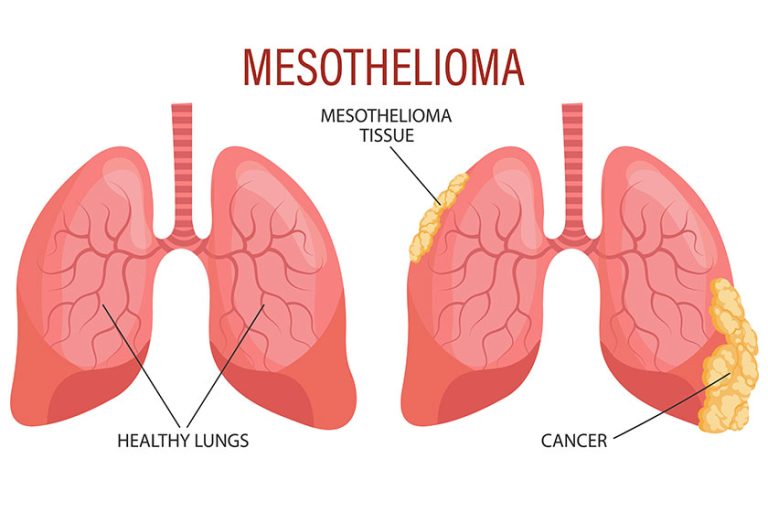 Stages mesothelioma lung disease healthcare medical infographic banner illustration vector Stages mesothelioma lung disease healthcare medical infographic banner illustration vector