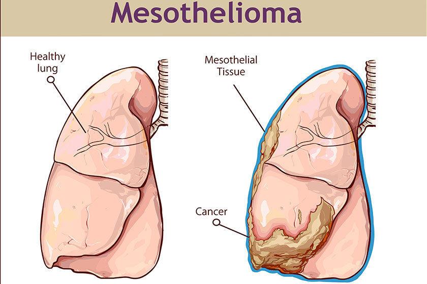 Vector illustration pleural mesothelioma