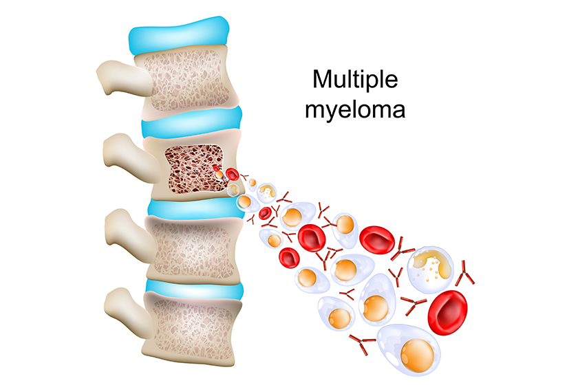 Multiple myeloma part vertebral column cross section vertebra bone structure