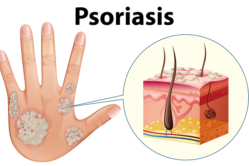 diagram showing psoriasis on human hand