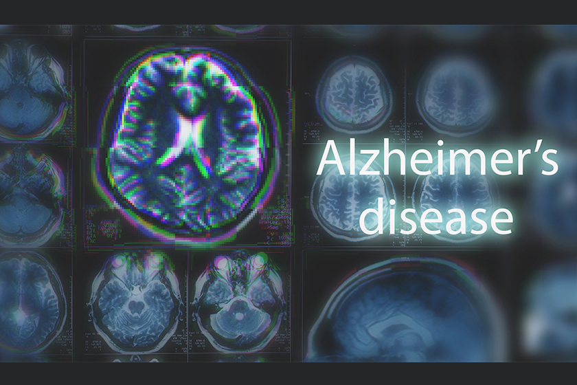 alzheimers disease or parkinson alzheimers disease or parkinson